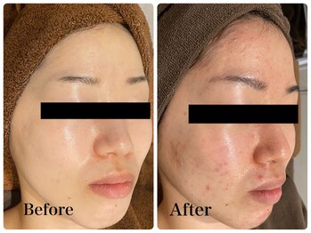 フルリールボーテ(Fleurir Beaut)/ニキビで本気で悩む方へ