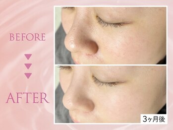 クリアラボ 池袋2nd(Clear Lab)/韓国肌管理&毛穴洗浄専門店