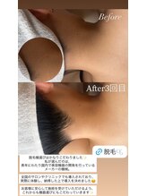 フジモトサロン 那覇おもろまち店(fujimotoサロン)/那覇/うなじ脱毛
