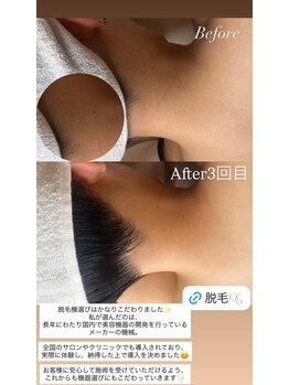 フジモトサロン 那覇おもろまち店(fujimotoサロン)/那覇/うなじ脱毛