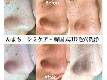 んまちの写真/<韓国式3D毛穴洗浄>自己流の毛穴ケアしていませんか??押し出さず浮かせる施術で毛穴がすっきり引き締まる★