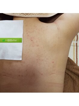 プラーベートサロン エクラ(eclat)/背中ハーブピーリング後日