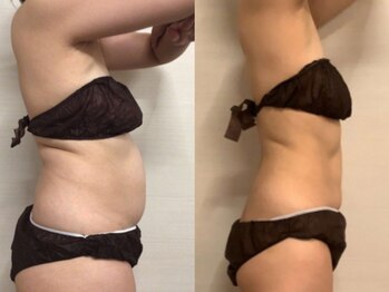 ジュメル 恵比寿店(Jumelles)/お腹集中ケア