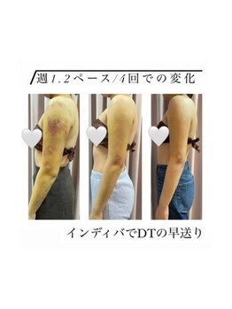 インディバケアプラチナム 横浜店/インディバ施術