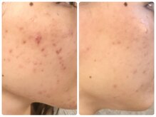 ラウン 京都(ROUN')/8回の施術ビフォーアフター