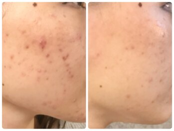 ラウン 京都(ROUN')/8回の施術ビフォーアフター