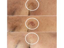 ハクビ(HAKUBI)/シミ改善