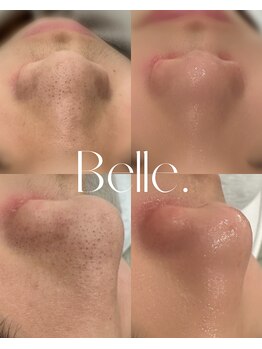 ベル(Belle)/【症例】毛穴洗浄