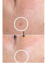 ラエッセ 目黒 白金台店(LAESSE)/毛穴・美白専門店 LAESSE 白金台