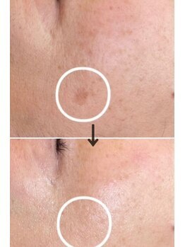 ラエッセ 目黒 白金台店(LAESSE)/毛穴・美白専門店 LAESSE 白金台