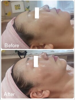 萬裡(マリン)/ワイコ水光ピール浮腫・たるみ