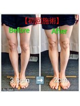 クシロ鍼灸整骨院/【O脚矯正】施術例