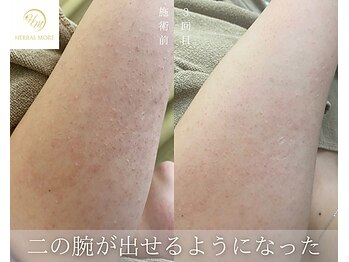 肌耕/二の腕のハーブピーリング