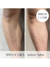 ココスターリー 香椎店(Coco starry)/男性・照射1回☆1ヶ月後