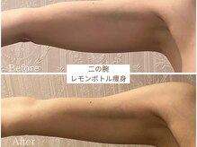 スマイルビューティラボ 別府店(Smile Beauty lab.)の雰囲気(二の腕【レモンボトル痩身◎】Before /After)