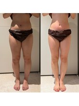 エムクオリティ(M-Quality)/夏に向けて下半身痩身エステ