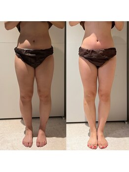 エムクオリティ(M-Quality)/夏に向けて下半身痩身エステ