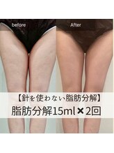 サンポ 神戸元町店(SANPO)/1５ml×2回