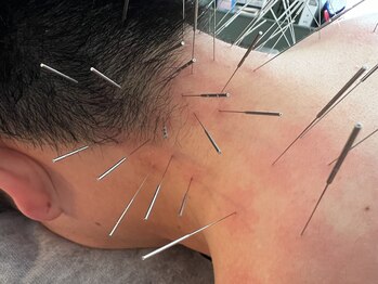 けんたろう鍼灸院/肩　首コリ