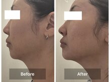 ミルジュ(MiLuJu)/美容溶解エンマ