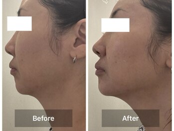 ミルジュ(MiLuJu)/美容溶解エンマ