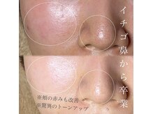 ３回の施術☆イチゴ鼻、卒業!全体はもちろん驚異のトーンアップ!