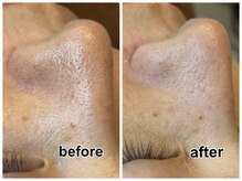 40代女性♪しつこい黒ずみもスッキリと！