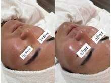 フェリス(FELIZ)/毛穴洗浄で自分史上最高の艶肌