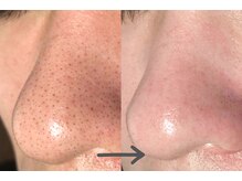 モネ(monet)/韓国式3D毛穴洗浄