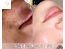 肌耕/顔のハーブピーリング