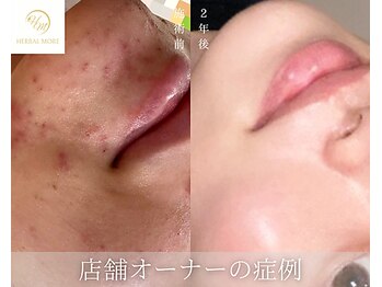 肌耕/顔のハーブピーリング