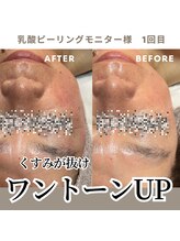 オルオル(.olu olu)/乳酸ピーリングモニター様