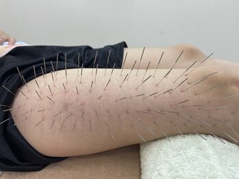 リサ鍼灸院(RISA鍼灸院)/ルート鍼