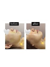 インディバケアプラチナム 横浜店/インディバ施術