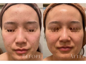 サロンドジョリー(Salon de Jolie)/ハーブピーリング→AEMILIA導入