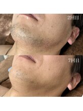 ランプ(LAMP)/～ハイブリッドヒゲ脱毛～