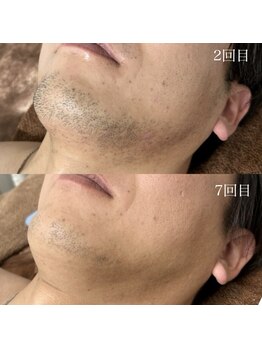 ランプ(LAMP)/~ハイブリッドヒゲ脱毛~