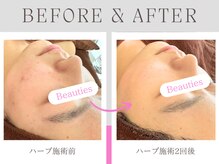 ビューティーズ(Beauties)の雰囲気（手強いニキビこそBeutiesの得意ジャンルです◎）