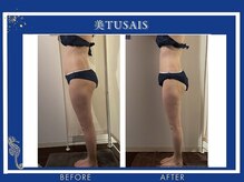 ビテュセ(美Tu sais)/【ダイエット・痩身】ボディケア