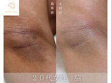 肌耕/脇のハーブピーリング