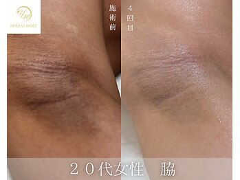 肌耕/脇のハーブピーリング