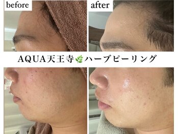 ホワイトアクア 天王寺本店(WHITE AQUA)/ハーブピーリング/大阪/天王寺