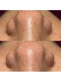 ビエン(bien)/韓国式3D毛穴洗浄