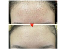 エミナル(eminal)/ビフォー/アフター/毛穴/ニキビ