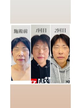 赤沼鍼灸整骨院/美・健康・笑顔に導く美容鍼