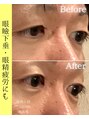 ココロ(COCORO)&nbsp;目の開きもパッチリ！施術１回のビフォーアフターです。