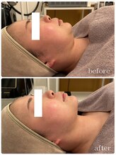 メゾンリュバン 梅田店(Maison Ruban)/エステ版オンダリフトプロ