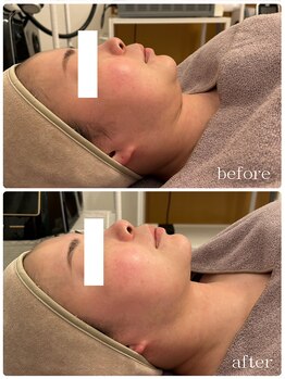 メゾンリュバン 梅田店(Maison Ruban)/エステ版オンダリフトプロ