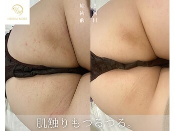 肌耕/お尻のハーブピーリング