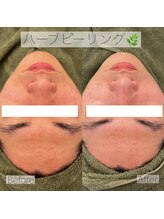 エステティックサロンR/1回でもお肌をキレイに！